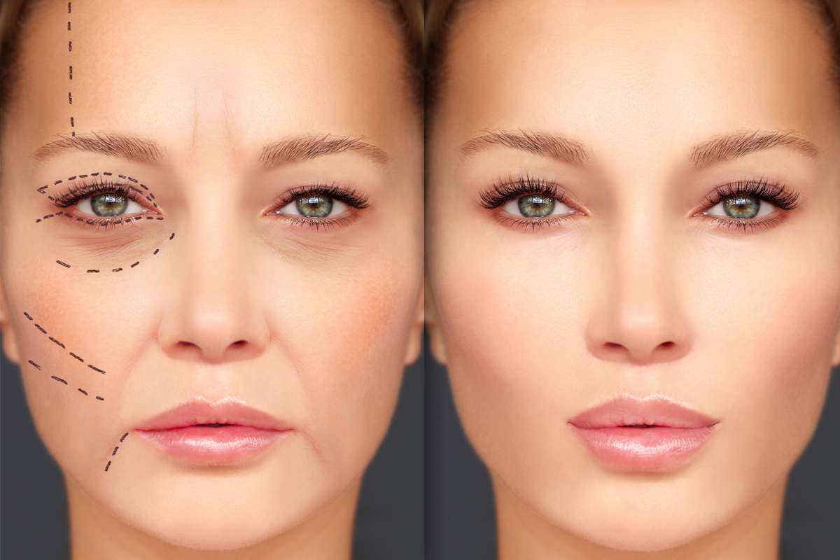 Before & After Botox vs Filler treatment