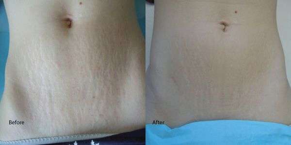 Before After Fractional laser CO2