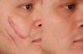 Before After Fractional laser CO2