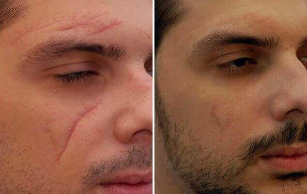 Before after scars treatment