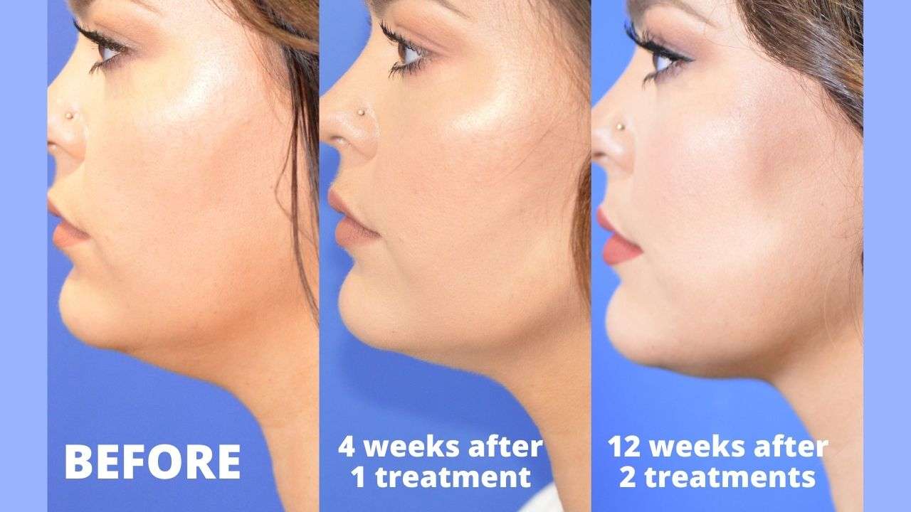 Before After double chin removal - Signature Aesthetica  TR