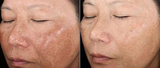 Before After Pigmentation treatment 