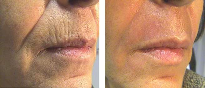 Signature Aesthetica  TR - Fractional for wrinkles removal