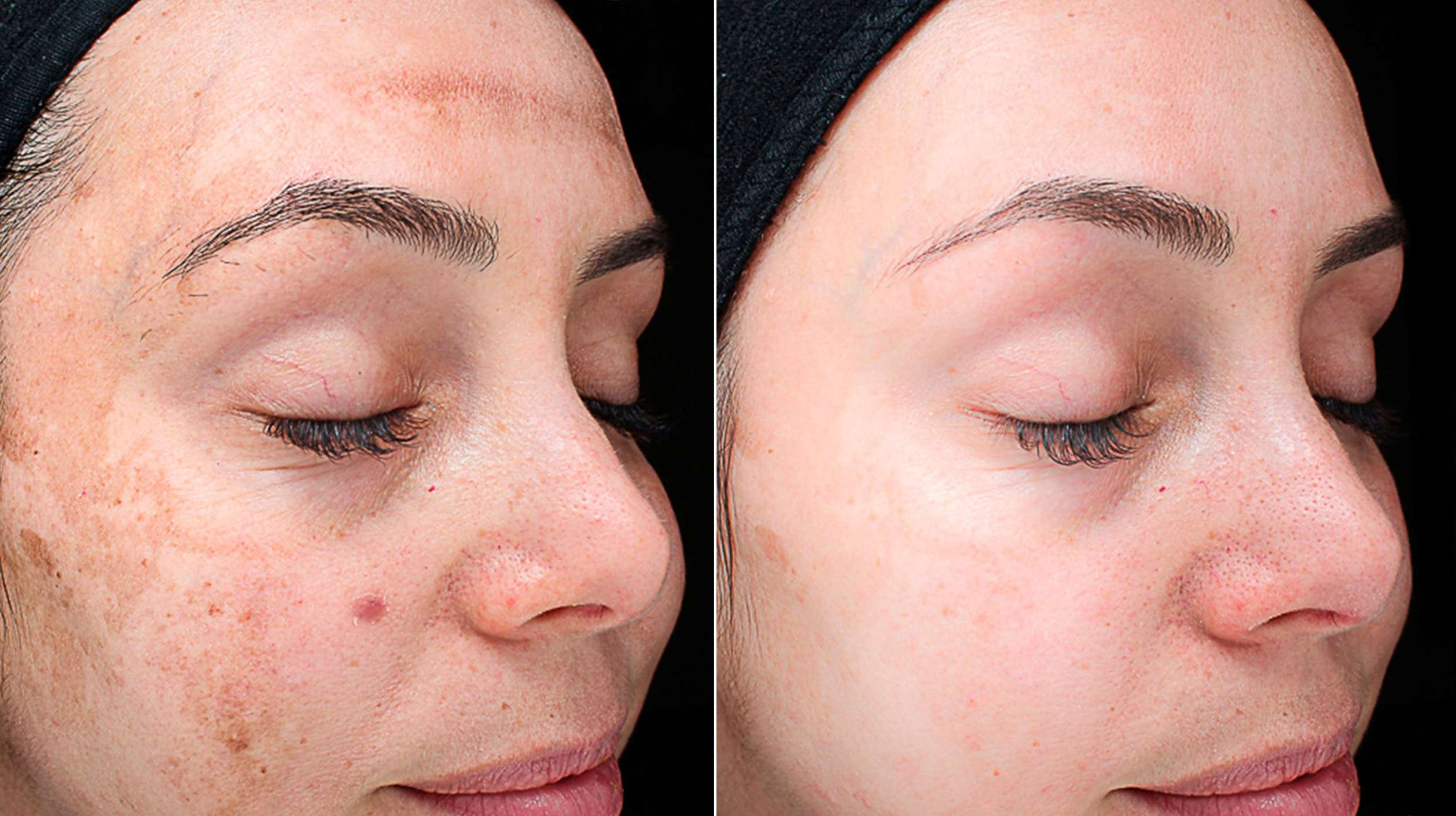 Before After Pigmentation treatment 