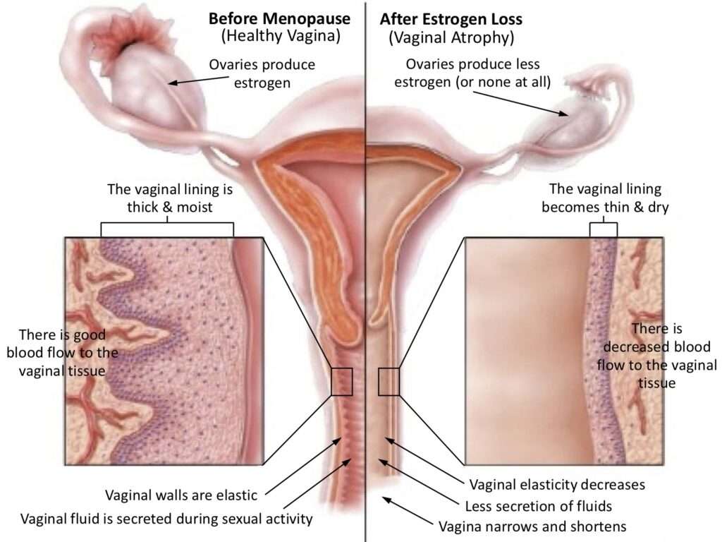 Laser Vaginal Rejuvenation