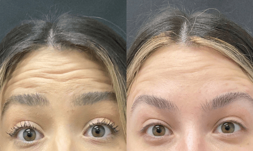 Before & After Botox vs Filler treatment