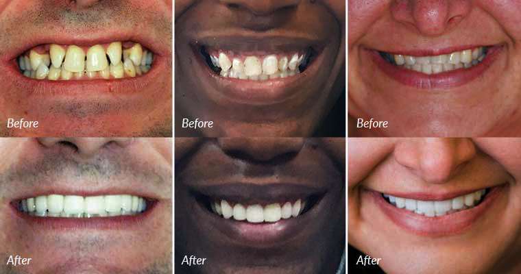 Before After Smile makeover Istanbul 