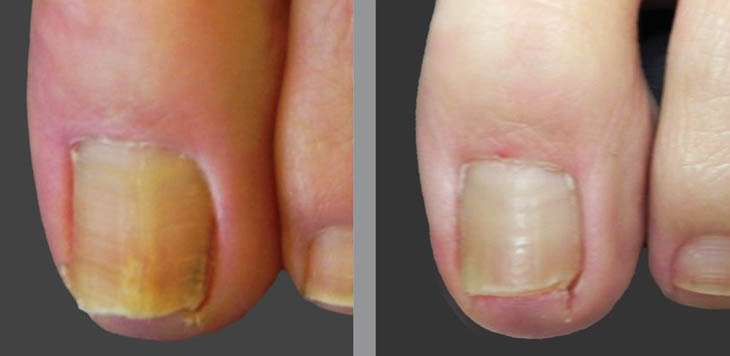 Before After nail fungus treatment (after 3 months)