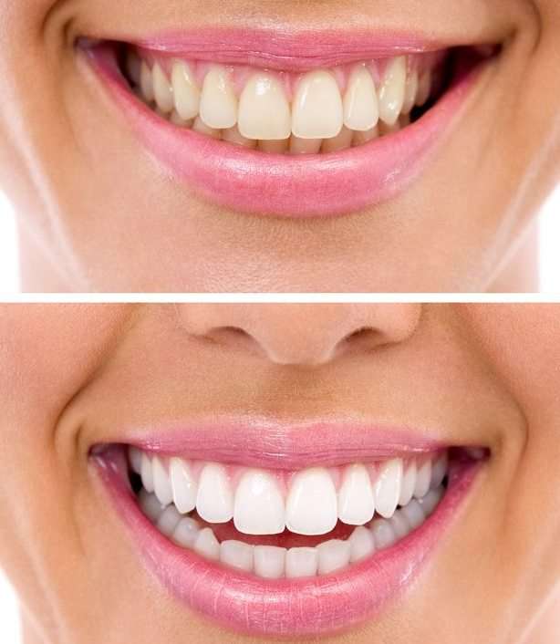 Teeth whitening, Brighter whites, guaranteed!