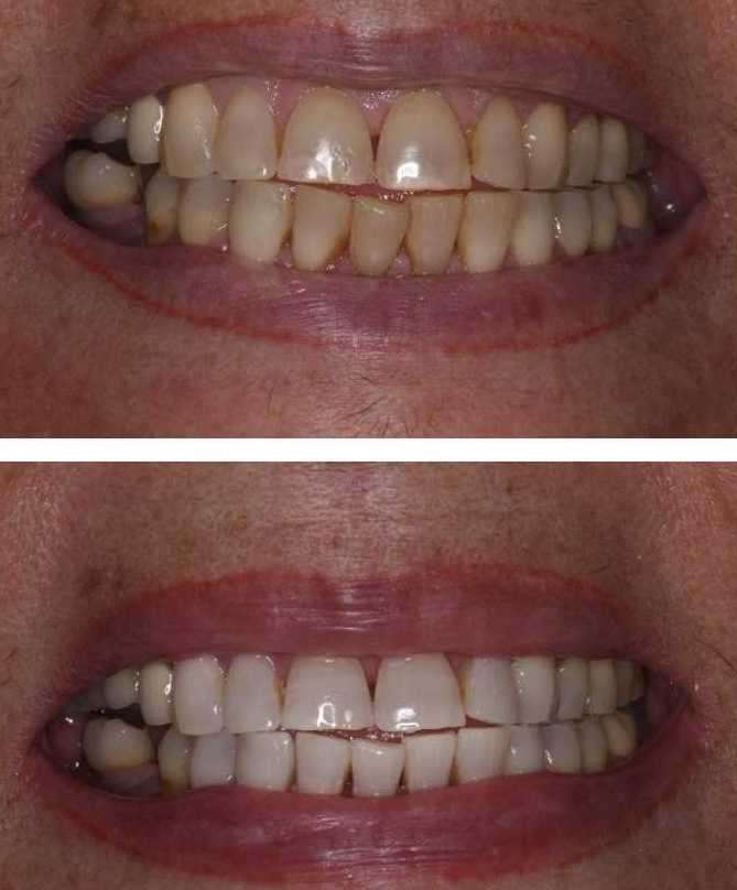 Before and after teeth whitening