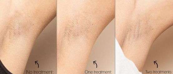 Laser hair removal