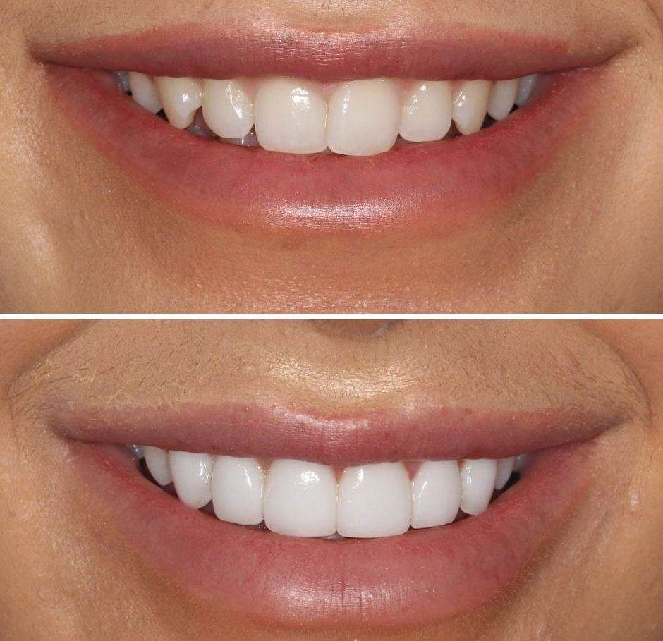 Smile Makeover, Beautiful Natural Smiles..