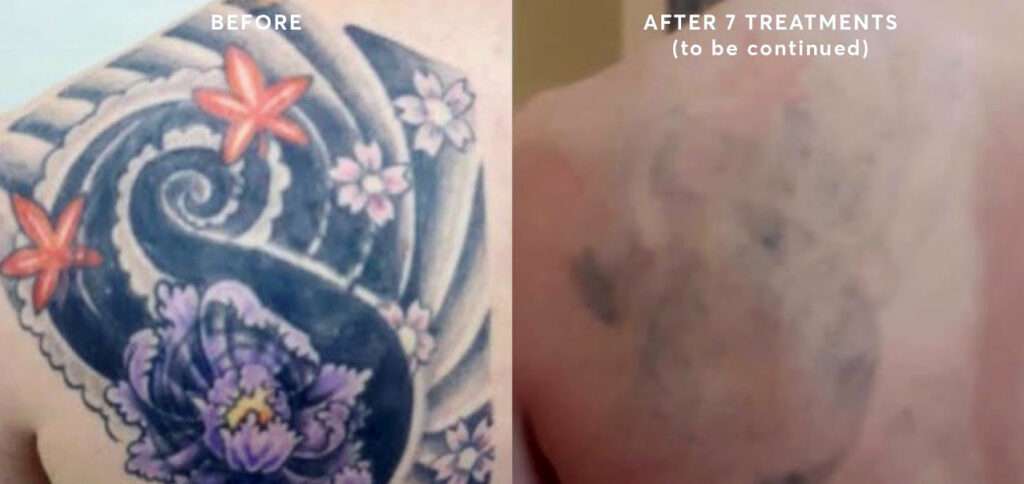 Laser tattoo removal in Istanbul