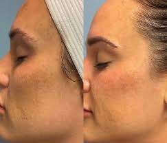 Before After chemical peels treatment in Istanbul