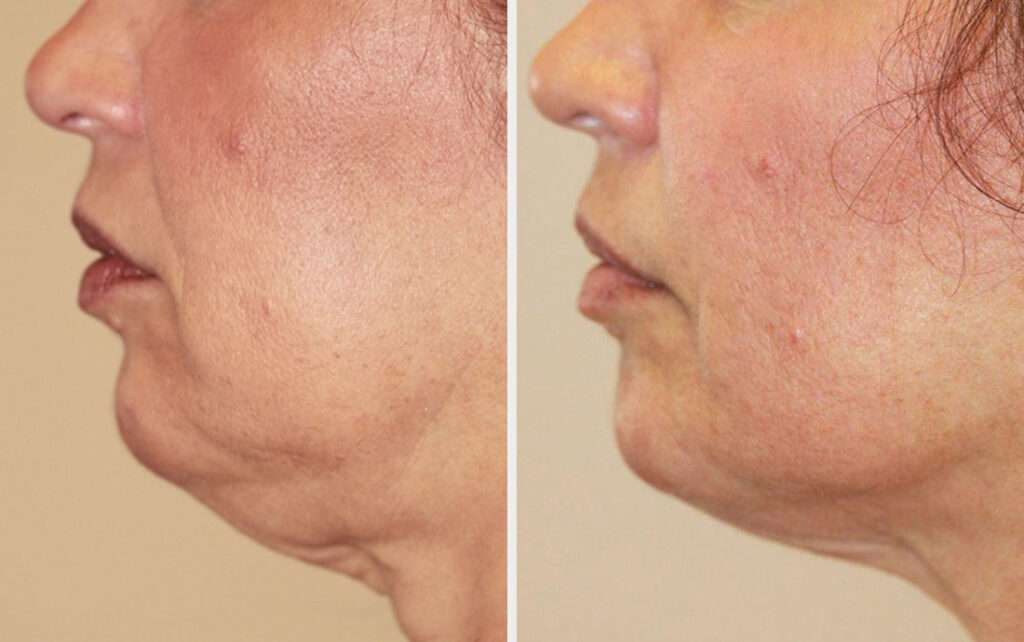 Before After RadioFrequency treatment (2 sessions later) 