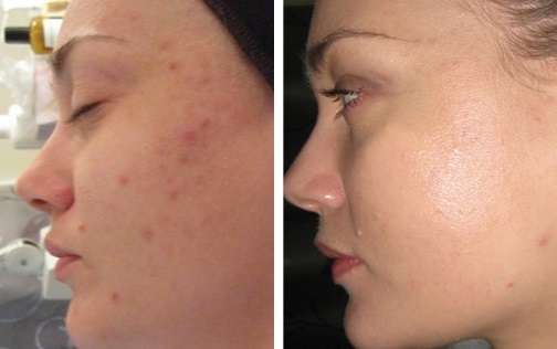 Before after Carbon peeling treatment in Istanbul (2 sessions)