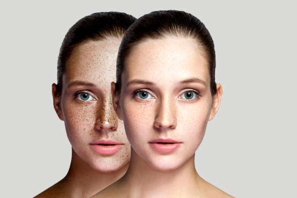 Best freckle treatment in Istanbul