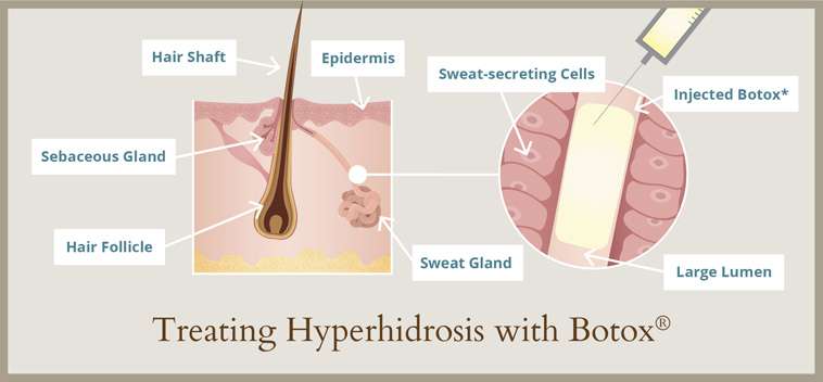 Hyperhidrosis treatment in Istanbul