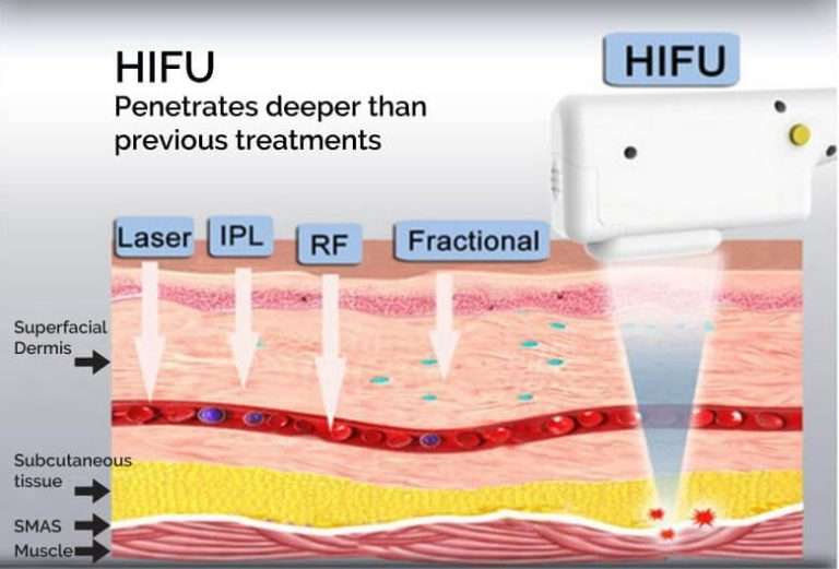 How deep HIFU treatment reach to skin layers