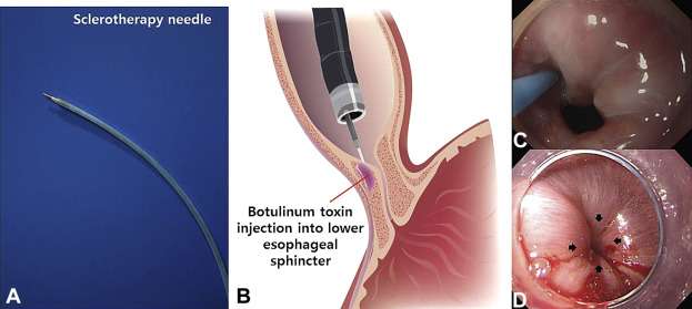 Gastric Botox in Istanbul