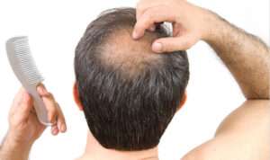 Home - Signature Aesthetica PRP for hair loss in Istanbul