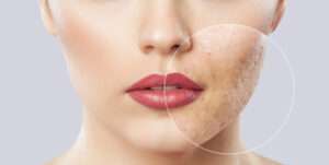 Home - Signature Aesthetica Punch excision treatment in Istanbul