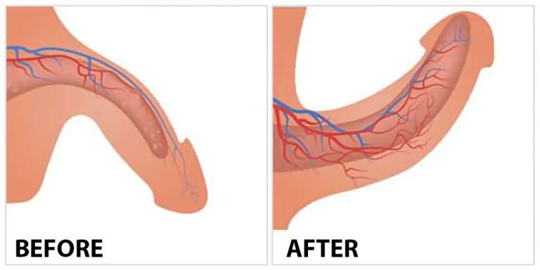 Before and After P.shot treatment for erectile dysfunction in Istanbul