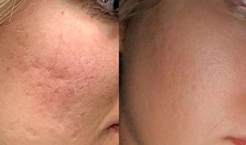 Before After Dermabrasion for Acne Scar