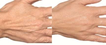 Hand filler, Reclaim the Beauty of Your Hands