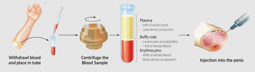 P-Shot treatment