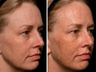 Melasma treatment