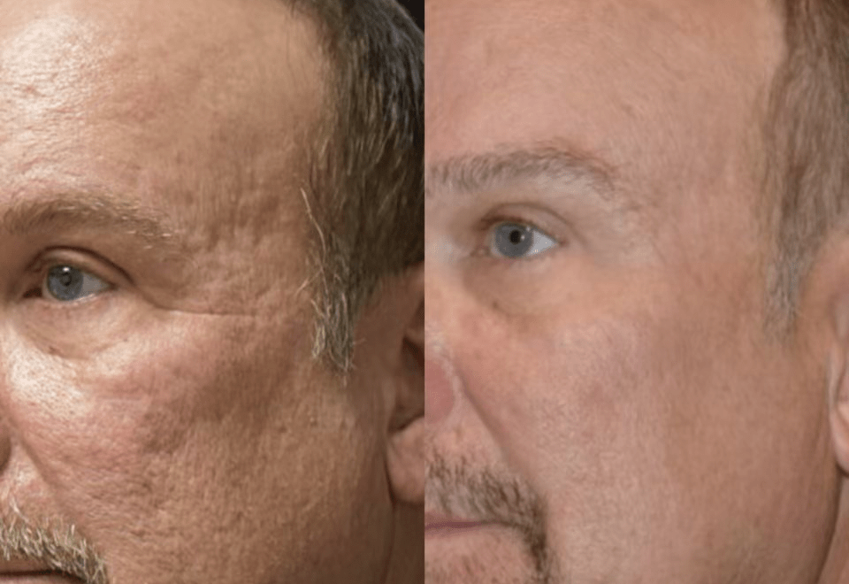 Before After Non-surgical anti-aging treatment options