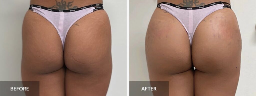 butt lift without surgery with filler before after 