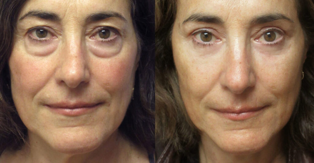 Blepharoplasty, Brighten Up with Beautiful Eyes!