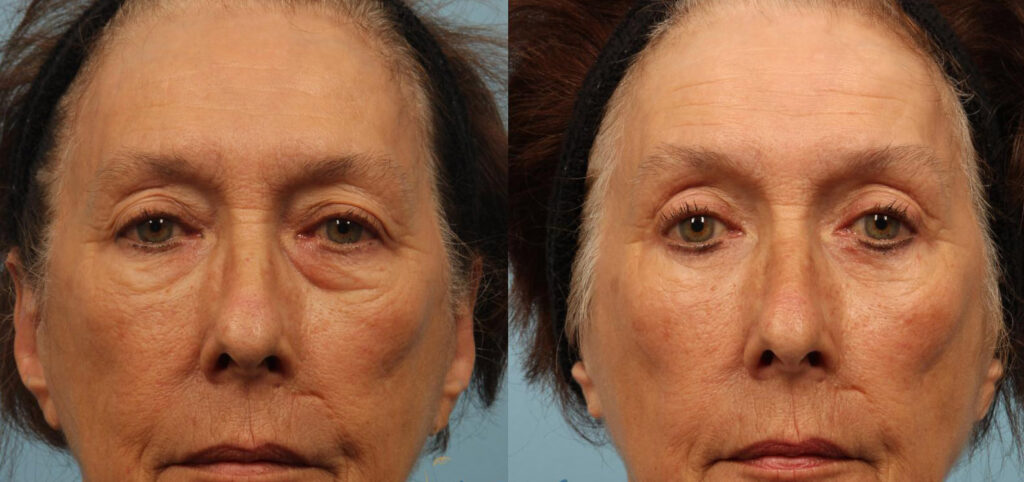 Blepharoplasty, Brighten Up with Beautiful Eyes!