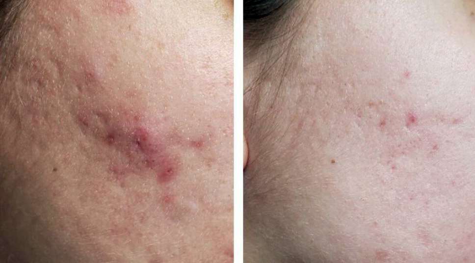 Scar treatment, Fresh, Clear & Beautiful Skin