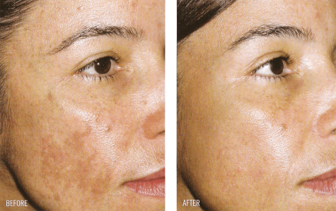 Pigmentation treatment, Look great, feel better!