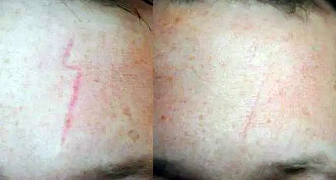 Scar treatment, Fresh, Clear & Beautiful Skin