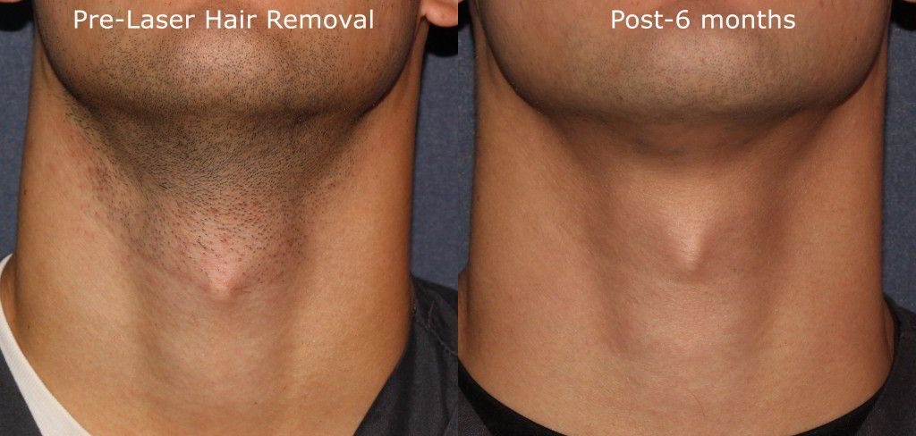 Laser Hair Removal