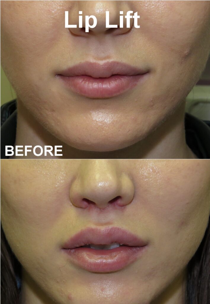 Lip Lift, Unlock the Secret to Youthful Lips