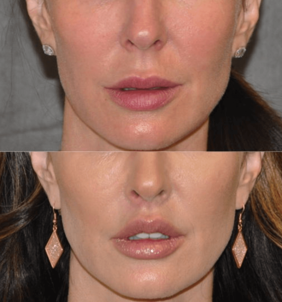 Before After Lip Lift in Istanbul