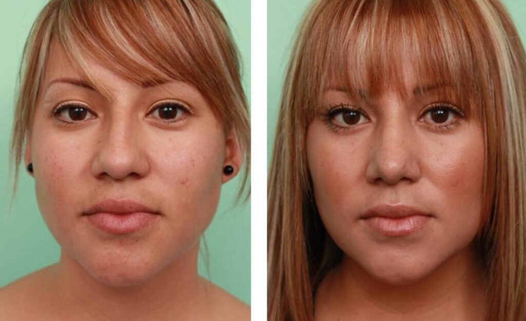 Before After Rhinoplasty in Istanbul - Turkey