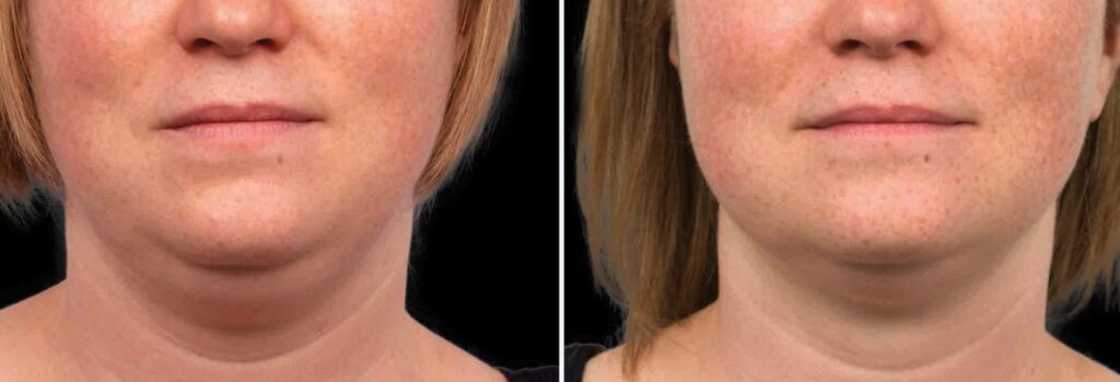 Double chin treatment: Best options