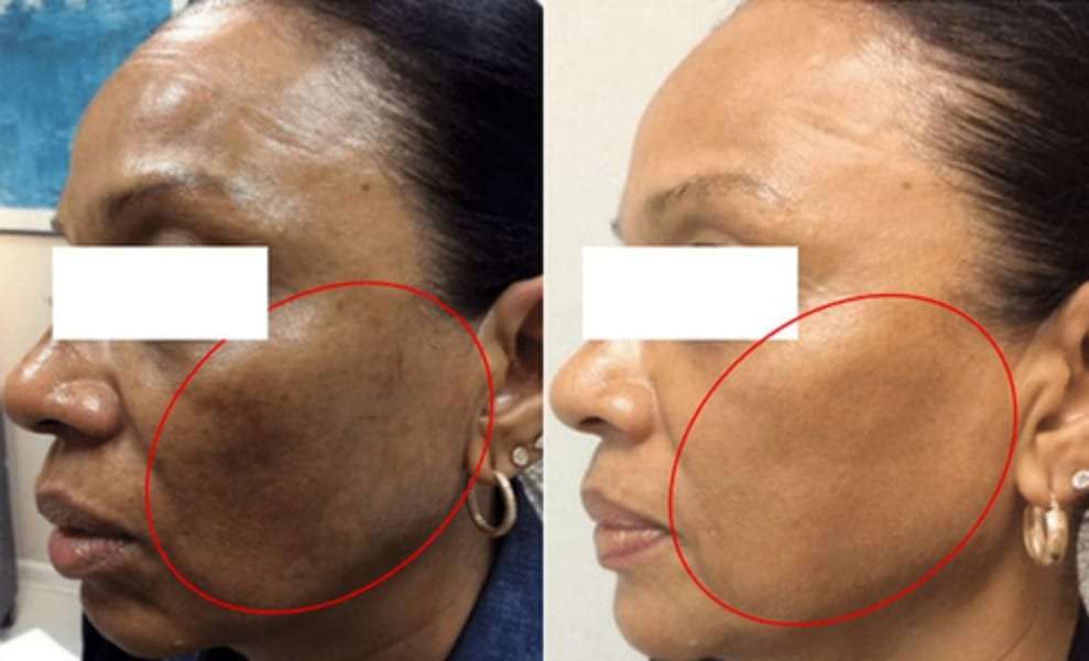 Pigmentation treatment, Look great, feel better!