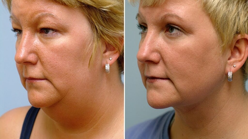 Double chin removal in Istanbul