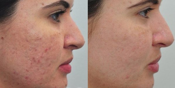 Before After Acne Treatment