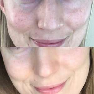 Freckle Treatment, Free your skin!