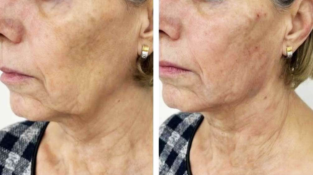 Non-surgical Skin Tightening, Best Beauty Hack