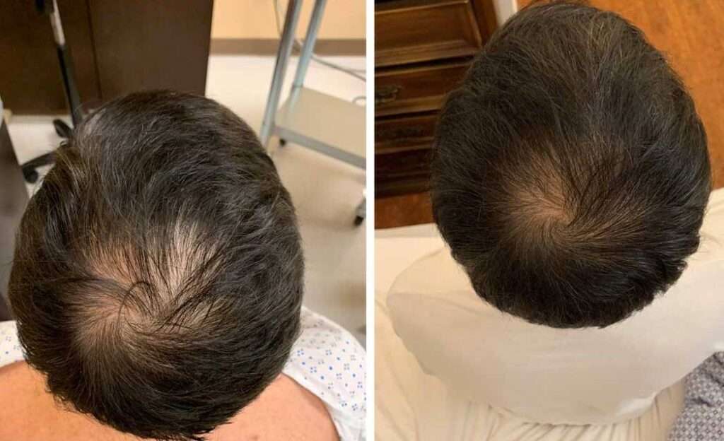 Your hair's best friend, PRP for hair loss! - Signature Aesthetica Your hair's best friend, PRP for hair loss!