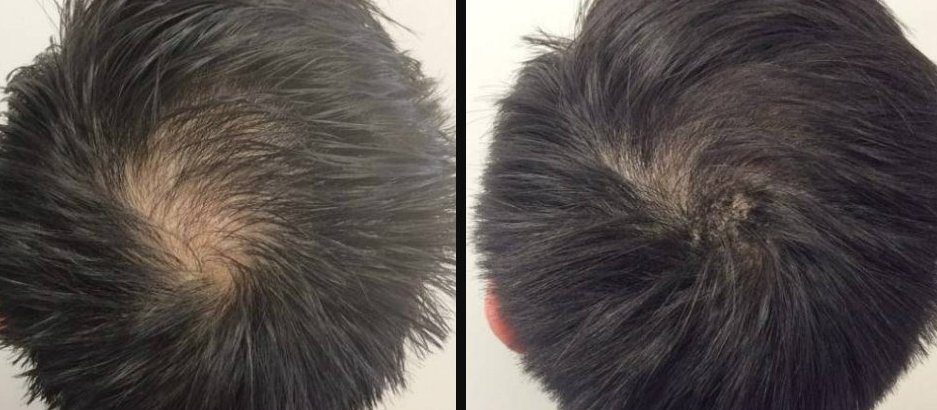 Your hair's best friend, PRP for hair loss! - Signature Aesthetica Your hair's best friend, PRP for hair loss!